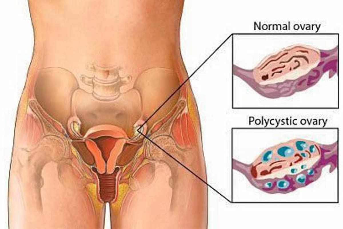 Según un artículo de la Revista Colombiana de Obstetricia y Ginecología, el síndrome de ovario poliquístico (SOP) es la endocrinopatía más frecuente en mujeres en edad reproductiva y produce un desarreglo hormonal que afecta la calidad de vida de las mujeres. La endometriosis, la amenorrea, dismenorrea y la menorragia, son otras de las enfermedades recurrentes. (Foto: Tomada de Internet / VANGUARDIA LIBERAL)