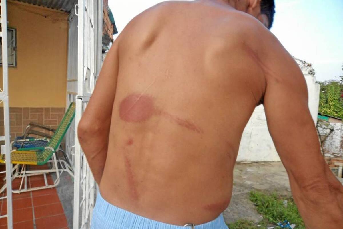 Golpes en la espalda y en los brazos son las evidencias, según los denunciantes, de la golpiza que les dieron. (Foto: Suministrada/VANGUARDIA LIBERAL )