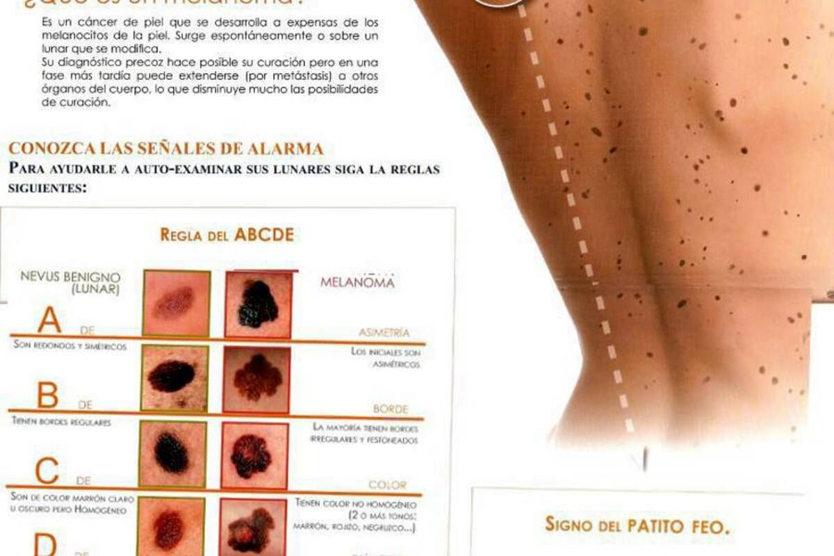 “El sistema general en seguridad social en salud debe invertir anualmente unos 300 millones de dólares para tratar a la población con cáncer de piel, un cáncer que es fácil de prevenir”. John Alexander Nova Villanueva, dermatólogo y epidemiólogo del Centro Dermatológico Federico Lleras Acosta. (Foto: Tomada de Internet / VANGUARDIA LIBERAL)