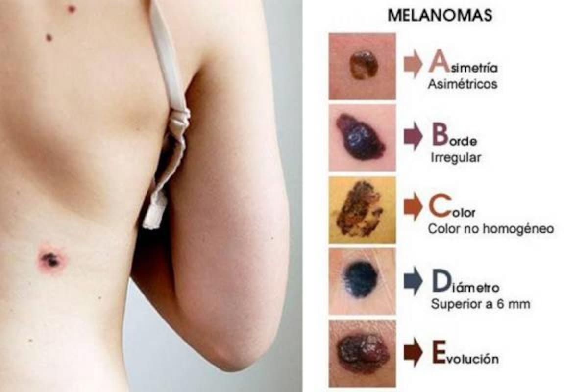 Un equipo de científicos uruguayos desarrolló un programa informático para ayudar a los dermatólogos a identificar lunares cancerígenos. Los científicos hicieron su estudio a partir de 700 imágenes dermatoscópicas.