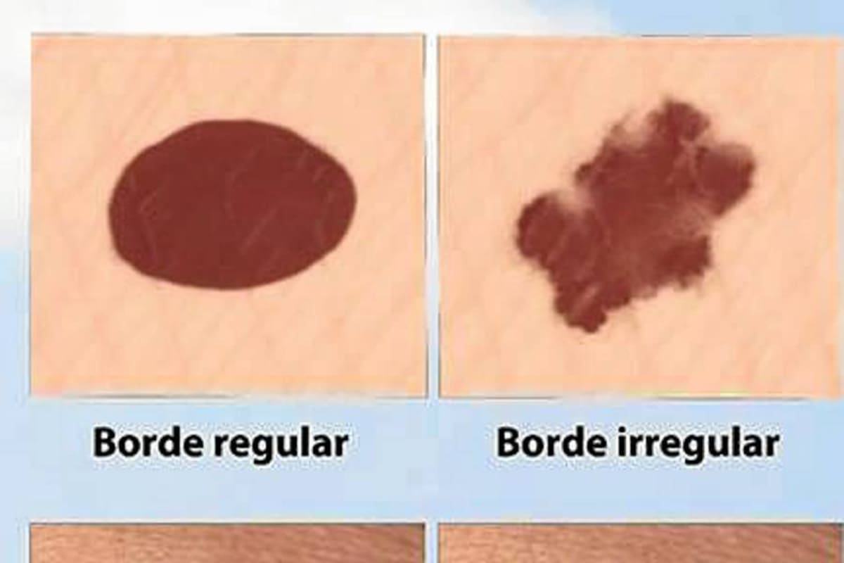 Después de los 30 años aparecen en la piel unas lesiones llamadas queratosis seborreicas o seniles y que pueden confundirse con lunares. Son benignas y no tienen ninguna significación. (Foto: Tomada de Internet / VANGUARDIA LIBERAL)