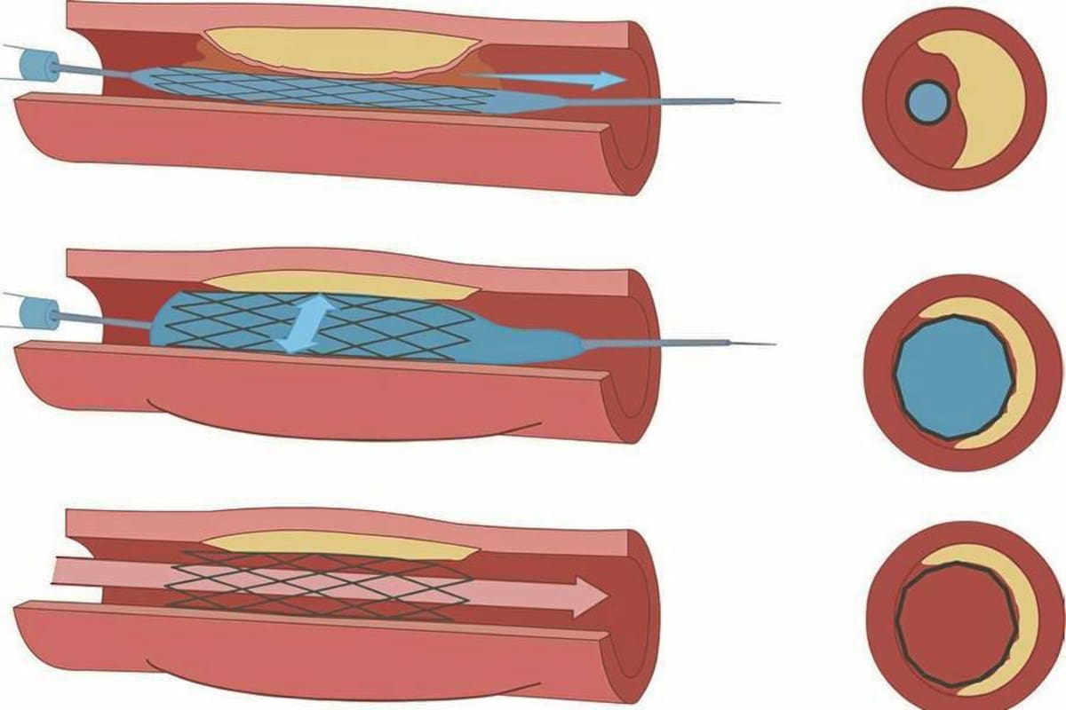 Los avances en la cirugía endovascular serán el tema del V simposio de cirugía vascular y endovascular - III curso postgrado cirugía vascular y endovascular: avances en el tratamiento de la enfermedad arterial de miembros inferiores / salvamento de la extremidad – pie diabético que se realizará los días 15 y 16 de marzo en el Club Campestre de Floridablanca. (Foto: Suministrada / VANGUARDIA LIBERAL)