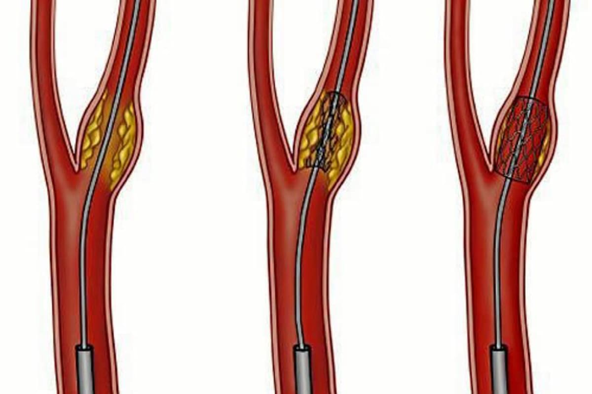 20% de los pacientes mayores de 70 años mueren durante la cirugía de amputación del pie diabético. Paradójicamente, la posibilidad de que se salve la extremidad a través de la cirugía endovascular de estos pacientes es alta. (Foto: Suministrada/VANGUARDIA LIBERAL)