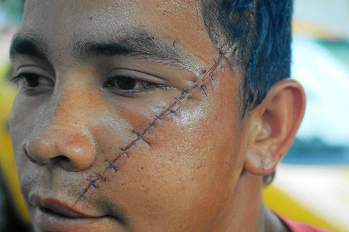 Aunque ayer en la tarde sería dado de alta del hospital Regional Magdalena Medio, el joven deben realizarle la cirugía maxilofacial. (Foto: Javier Alvarado/ VANGUARDIA LIBERAL)
