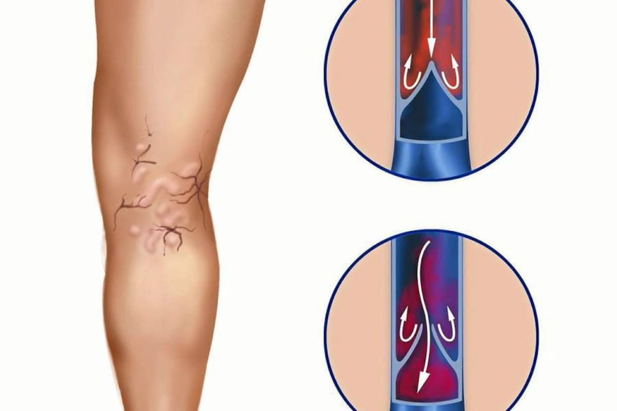 Los pacientes de vena várice que recurren a la cirugía deben complementar este tratamiento con un peso saludable, evitar el uso de hormonas y tomar medidas de higiene venosa. (Foto: Tomada de Internet / VANGUARDIA LIBERAL)