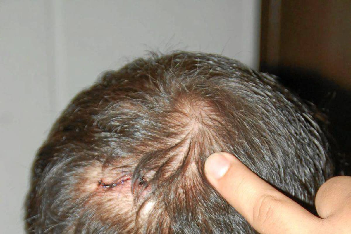 Con cuatro puntos los médicos suturaron la herida del hombre que fue asaltado por delincuentes armados, quienes utilizaron el arma para provocarle heridas en la cabeza. (Foto: Édgar Pernett/ VANGUARDIA LIBERAL)