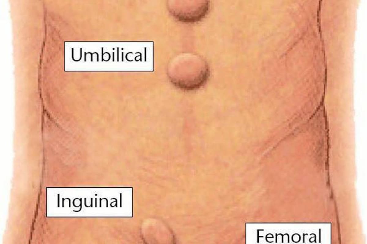La hernia adquirida es una de las más frecuentes. Existe una predisposición familiar en el 25% de los pacientes. En otros es el aumento de la presión intraabdominal como principal causa: estreñimiento, síndrome prostático en el hombre, bronquitis crónica, enfisema pulmonar, asma, levantadores de pesas. (Foto: Tomada de Internet / VANGUARDIA LIBERAL)