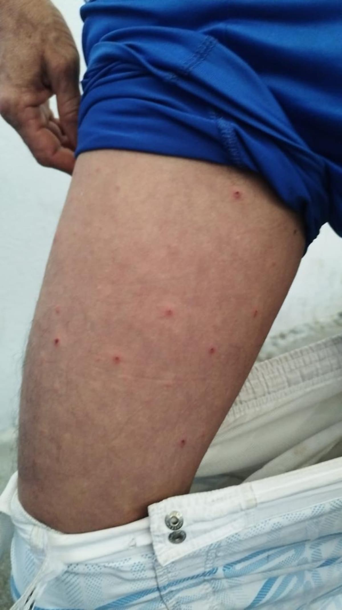 Las autoridades ordenaron a dichos establecimientos fortalecer las medidas preventivas contra posibles contagios por varicela.