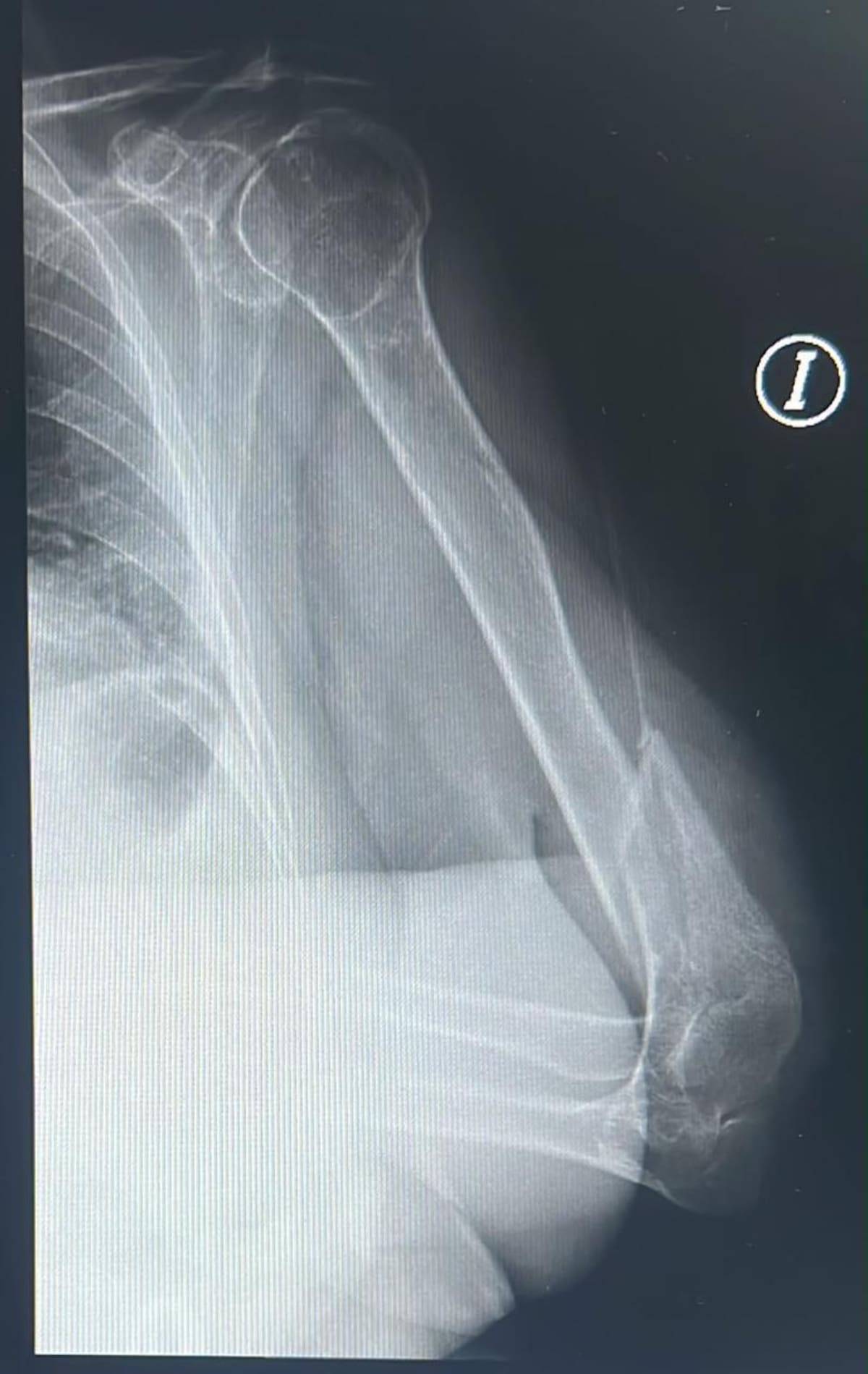 Según la denuncia, el hombre la empujó y presuntamente le causó una fractura en un brazo. Foto: captura de video
