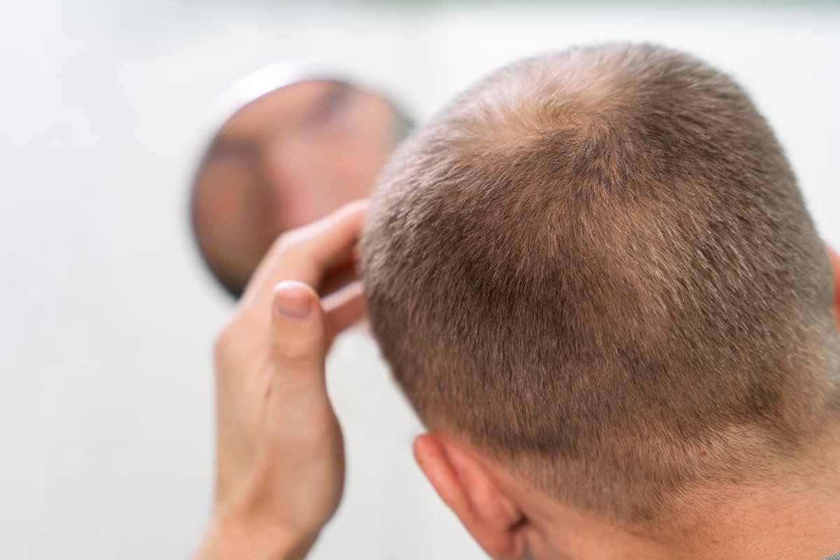 Alopecia y radiación UV: La importancia de proteger la piel ante la pérdida de cabello.