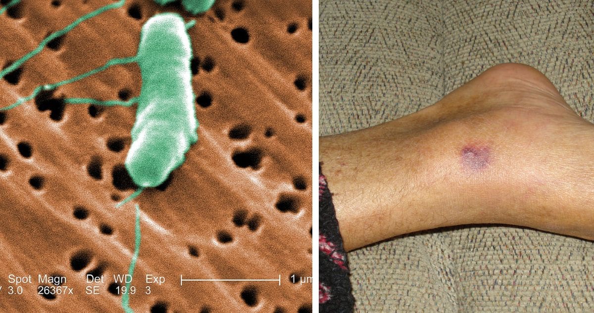 lorida y Luisiana concentran la mayoría de los casos de la bacteria 'come carne' y muertes reportados este año.