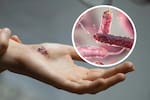 Bacteria ‘come carne’ en Estados Unidos: suman 12 muertos en Luisiana y Florida en 2026