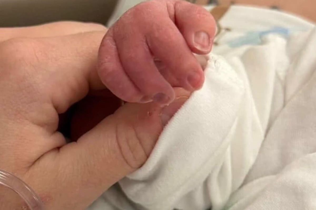 Un bebé se volvió viral luego de que sus padres compartieran imágenes en redes de una rara condición congénita que afecta una de sus manos.