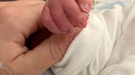 Bebé nace con una extraña malformación en la mano y conmueve en redes