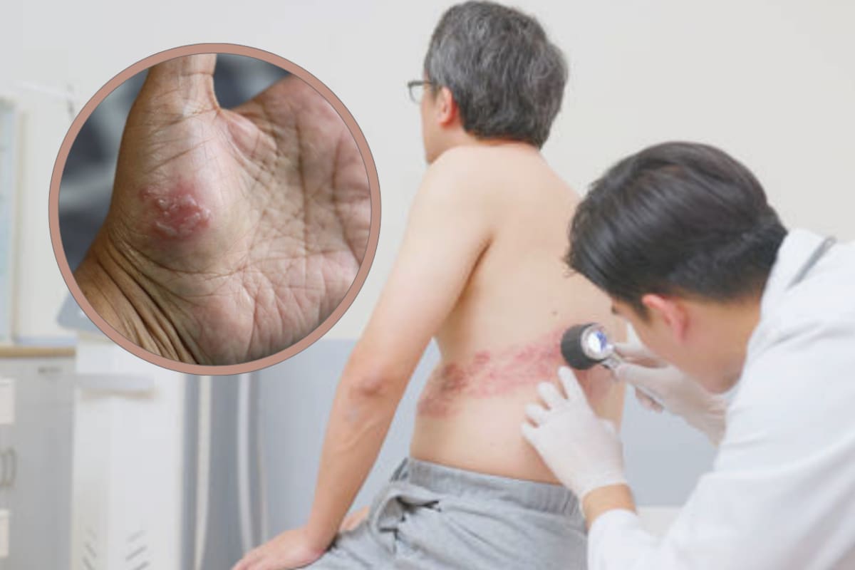 Especialistas recomiendan a los mayores de 50 años consultar con su médico sobre medidas de prevención frente al herpes zóster. Imagen tomada de: Istock