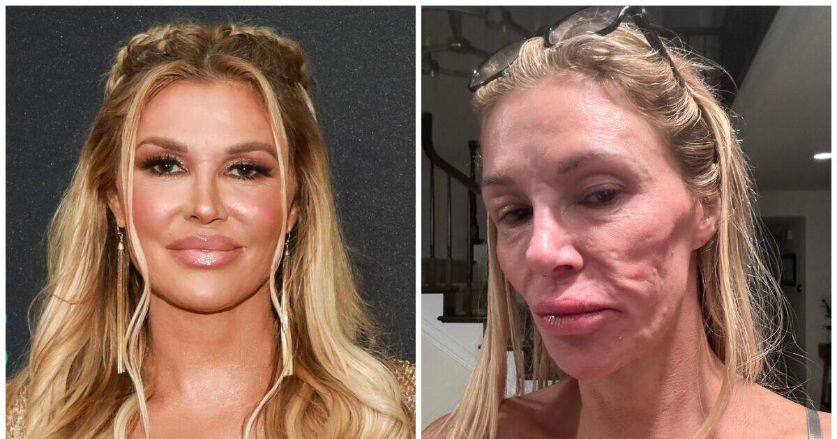 La estrella de reality, Brandi Glanville, sorprendió a sus fanáticos cuando su cirugía de extracción de implantes resultó en la recepción de nuevos implantes mamarios.