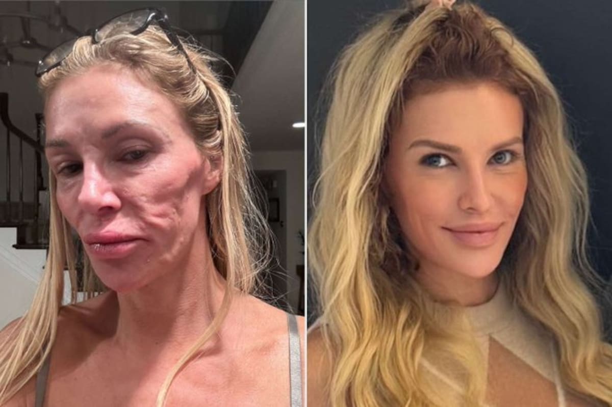Brandi Glanville, exactriz de 'Real Housewives of Beverly Hills', finalmente determinó la fuente del agresivo parásito facial contra el que ha estado luchando durante tres años.