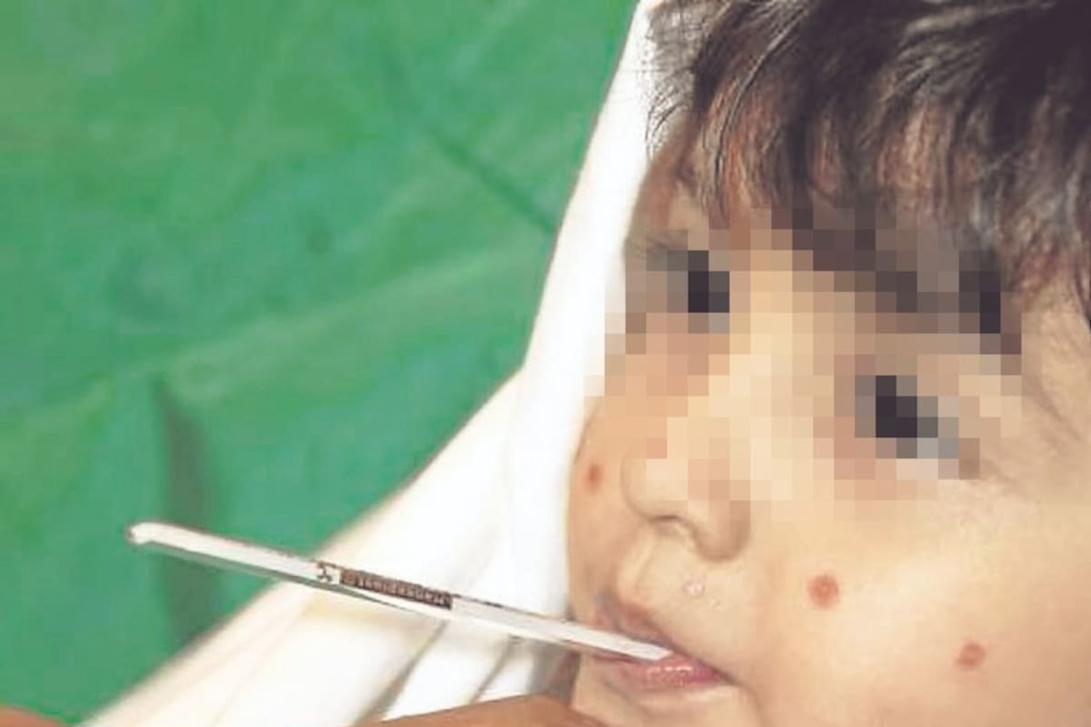 Casos de varicela en niños, en colegio de Bucaramanga.