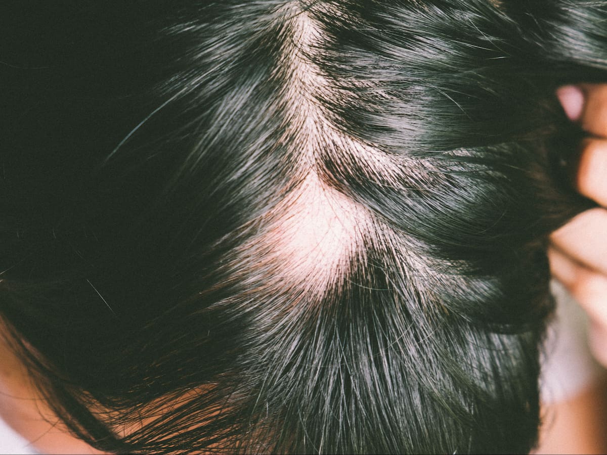 Expertos de Mediarte, clínica especializada en implante capilar en Colombia, revelan los secretos genéticos y hormonales que determinan los patrones de pérdida de cabello en los hombres | Foto: Canva