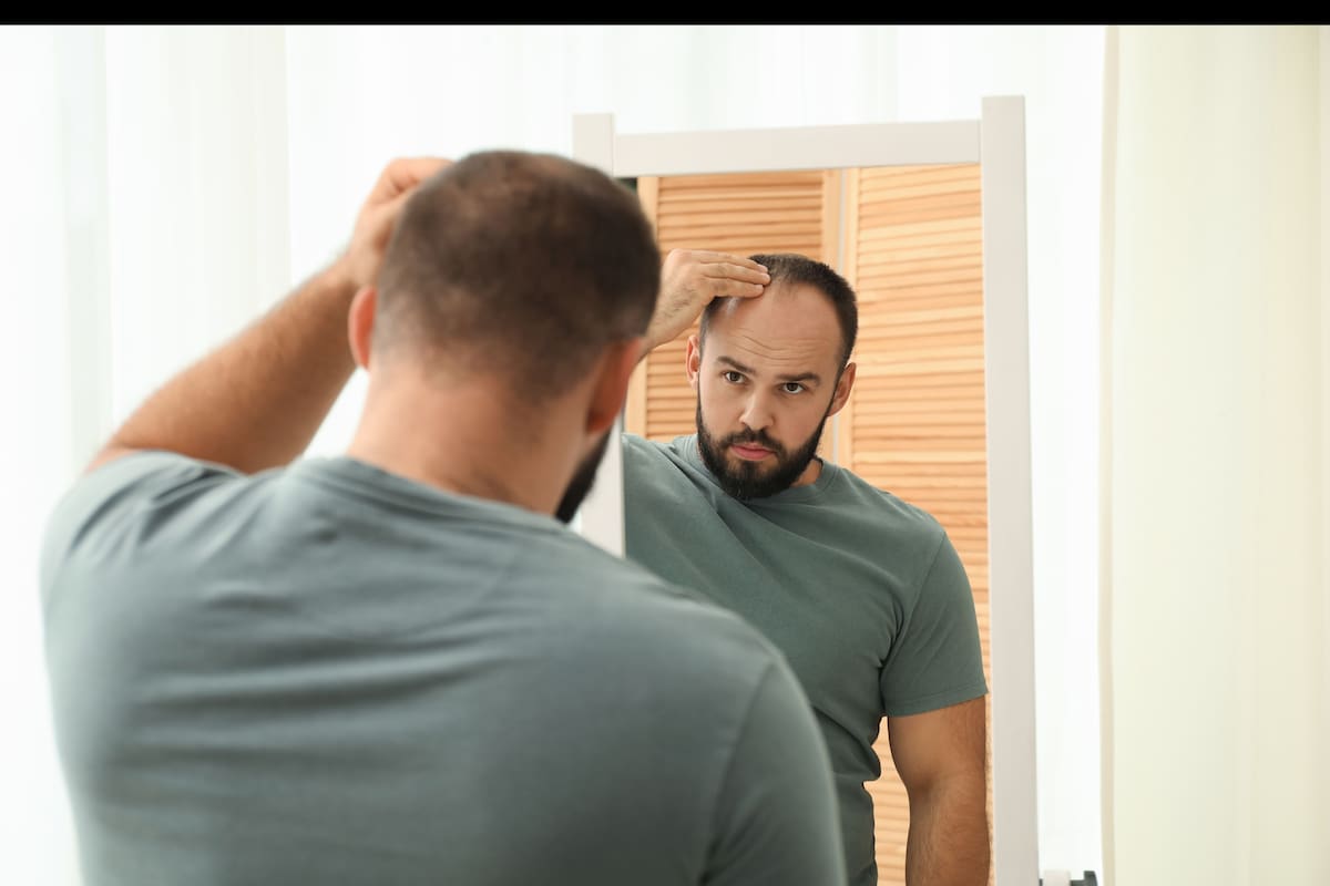 Expertos de Mediarte, clínica especializada en implante capilar en Colombia, revelan los secretos genéticos y hormonales que determinan los patrones de pérdida de cabello en los hombres | Foto: Canva