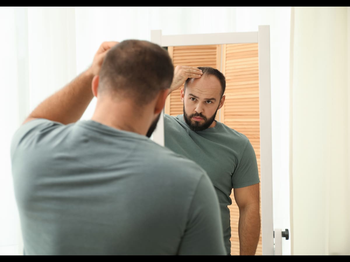 Expertos de Mediarte, clínica especializada en implante capilar en Colombia, revelan los secretos genéticos y hormonales que determinan los patrones de pérdida de cabello en los hombres | Foto: Canva