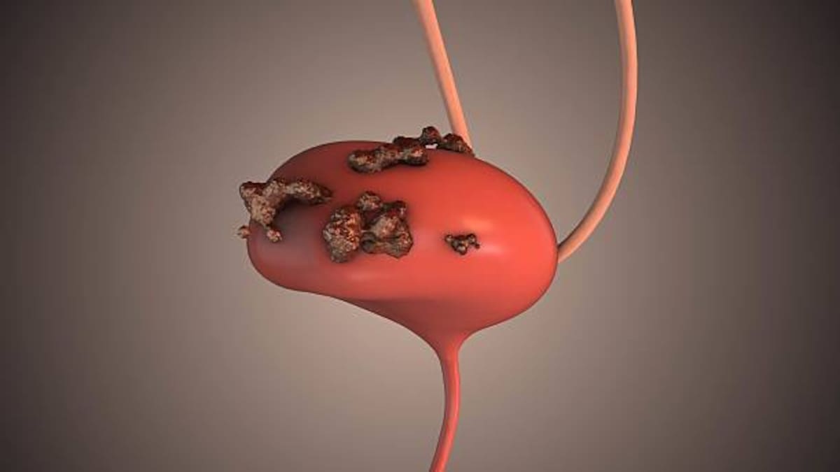 Las personas con factores de riesgo específicos pueden necesitar un plan de detección del cáncer diferente al de la población general.