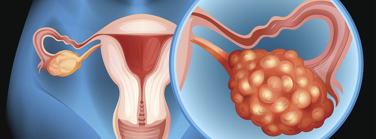 La inflamación abdominal persistente podría ser una señal de alerta del cáncer de ovario. En su día mundial, te contamos cuáles son los síntomas “silenciosos” que salvan vidas y cómo la genética está cambiando el pronóstico en Colombia.