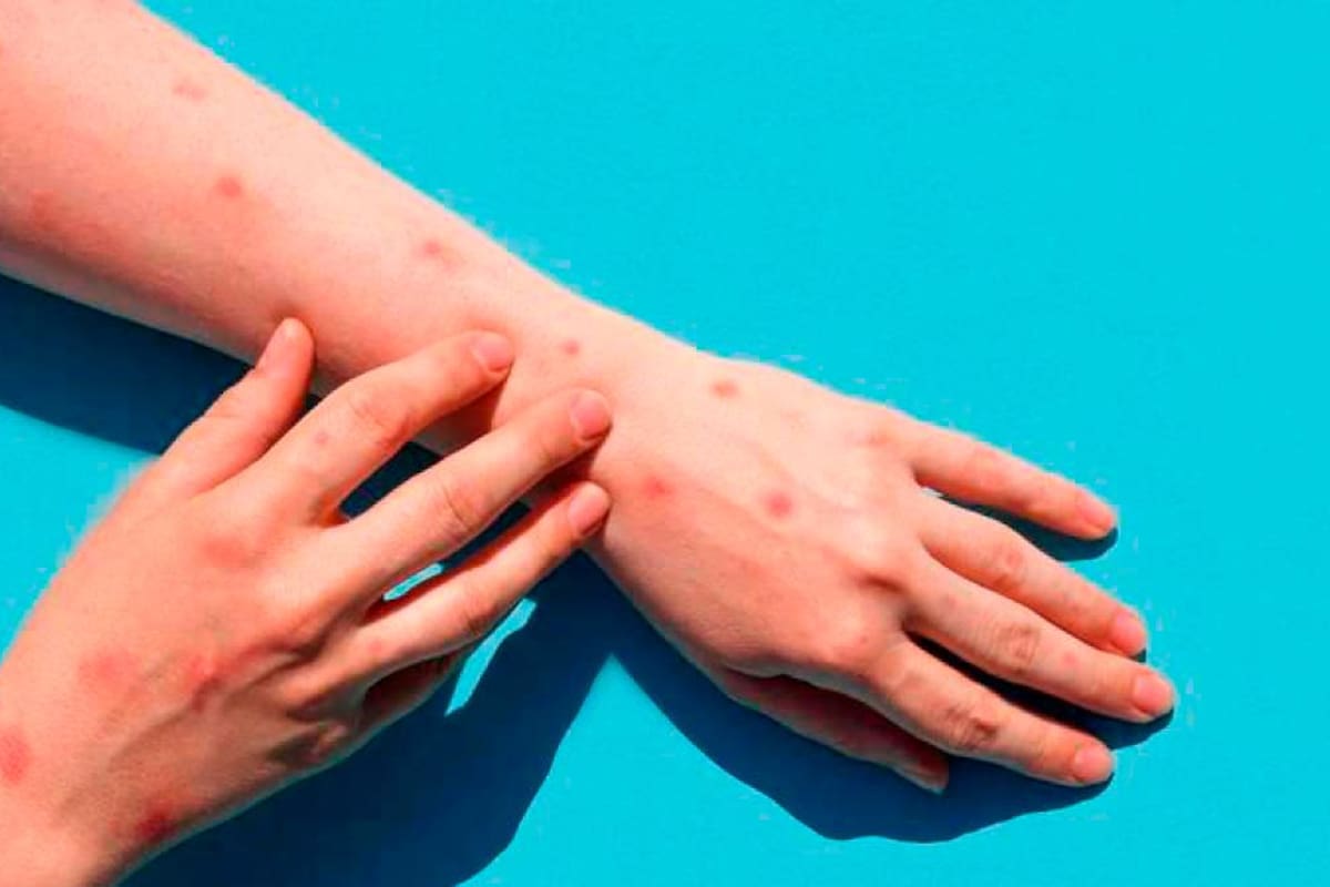 Continúa la prevención de la viruela del mono en Sucre.