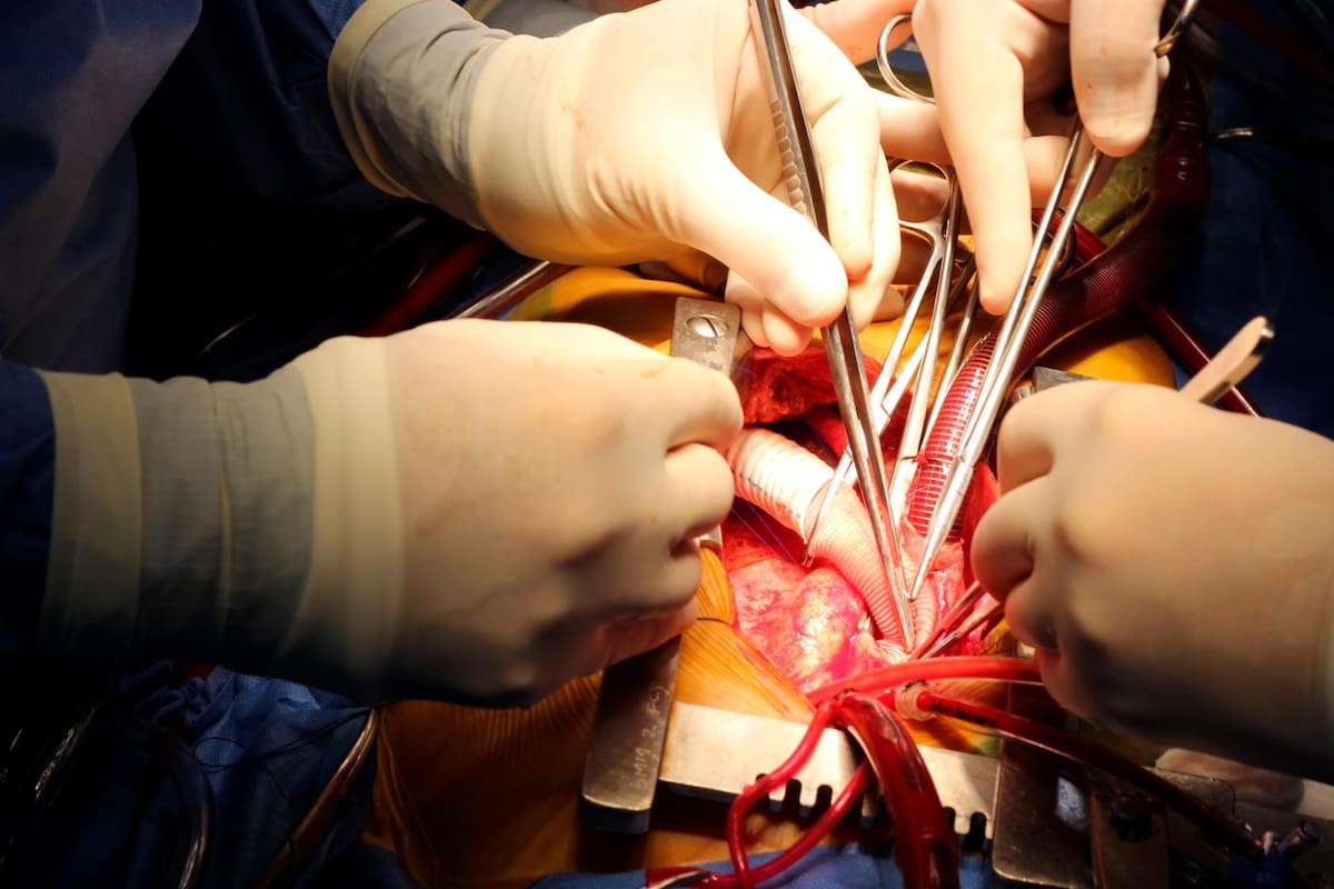 En 2014 la Fundación Cardiovascular implantó por primera vez un corazón artificial en Suramérica, llamado ‘HeartMate II’, en una paciente de 56 años. (Foto: Fernanda Sandoval / VANGUARDIA)