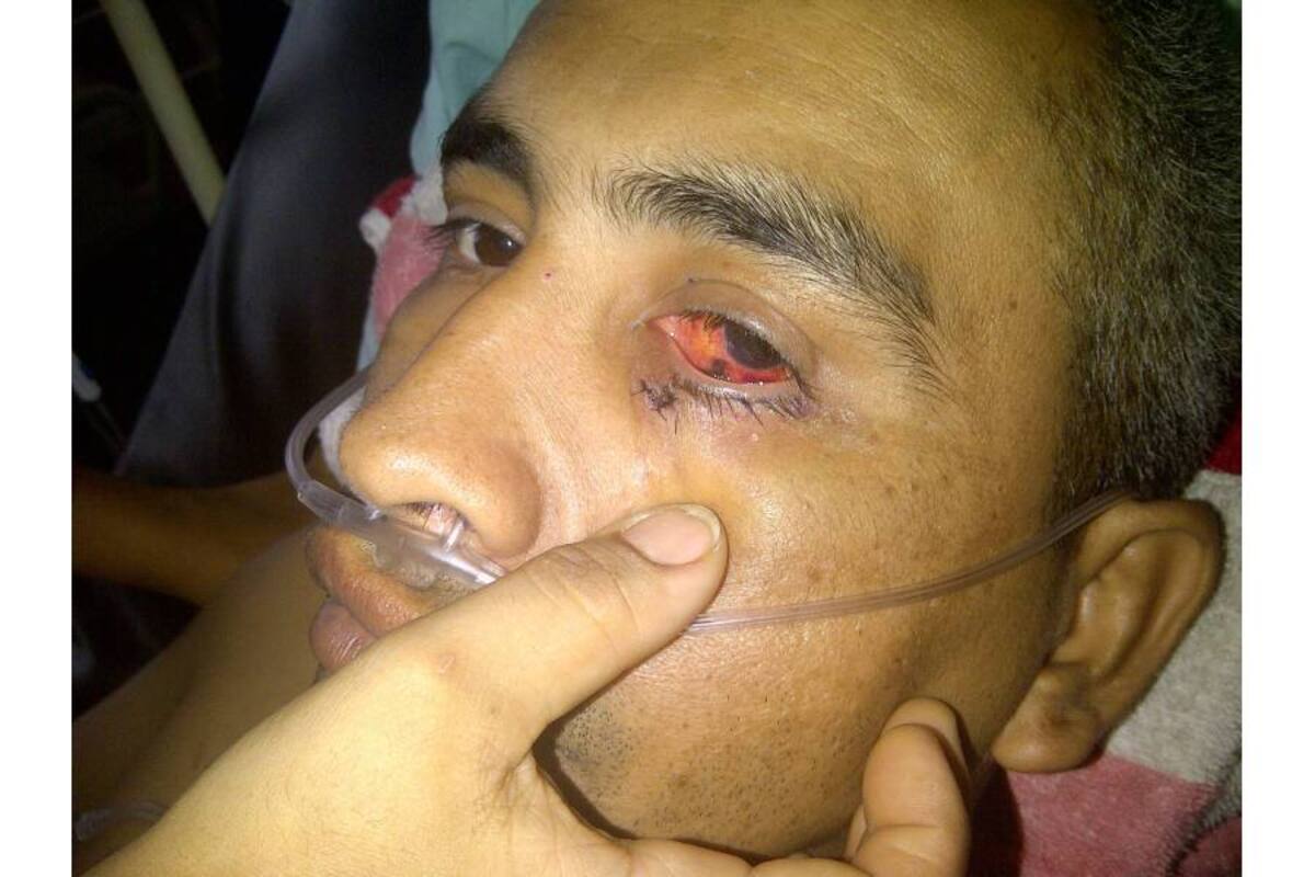 Una de las esquirlas del artefacto explosivo afectó el ojo izquierdo de Duberney Betancur. (Foto: Suministrada/ VANGUARDIA LIBERAL)