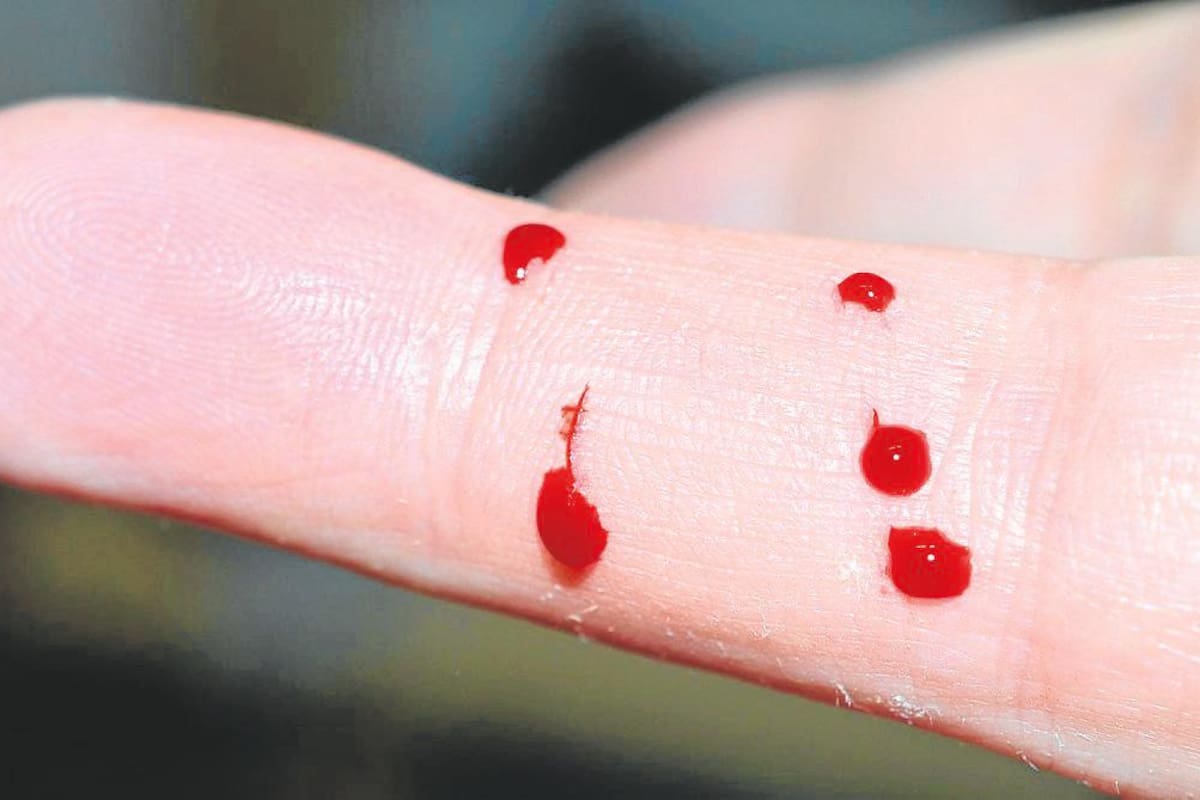 Un paciente con hemofilia debe llevar un tratamiento basado en la infusión periódica de concentrados de factor de coagulación para evitar hemorragias.