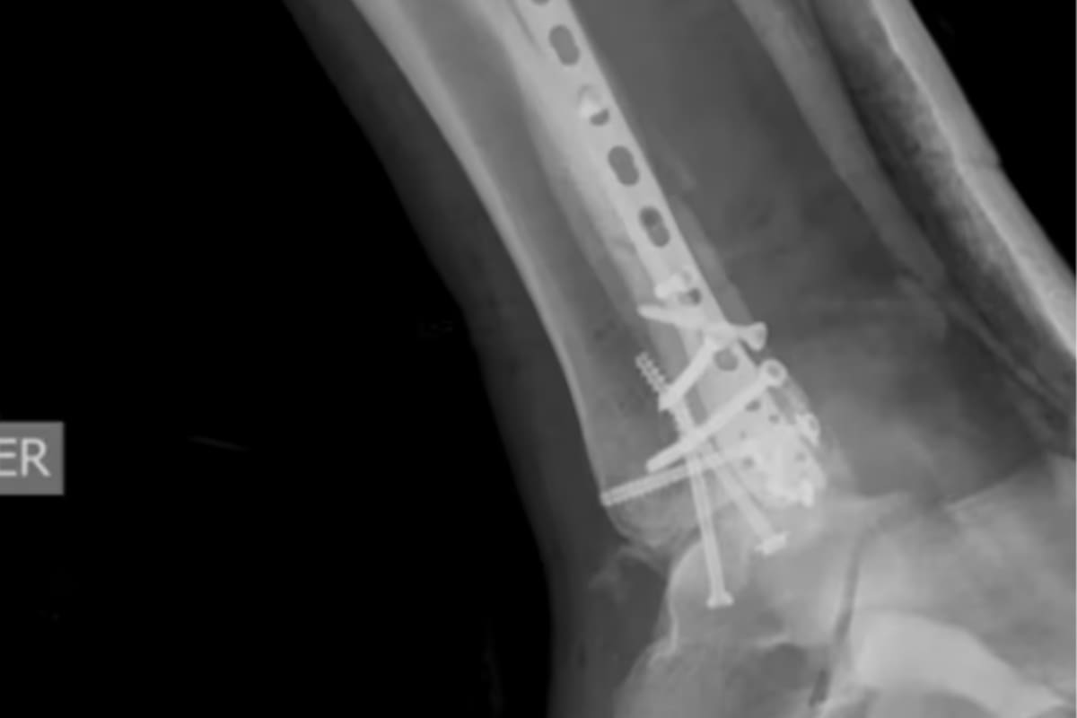 El presentador aseguró que la caída le dejó varias fracturas en la pierna derecha y que decidió compartir su experiencia para que otras personas aprendan de los errores que, según dijo, cometió durante el aterrizaje. Captura de video // Youtube