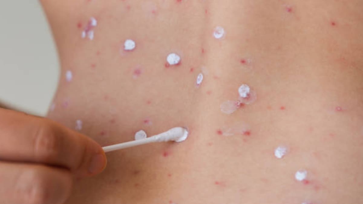 El herpes zóster puede provocar dolor intenso y erupciones en un solo lado del cuerpo o del rostro. Foto de referencia