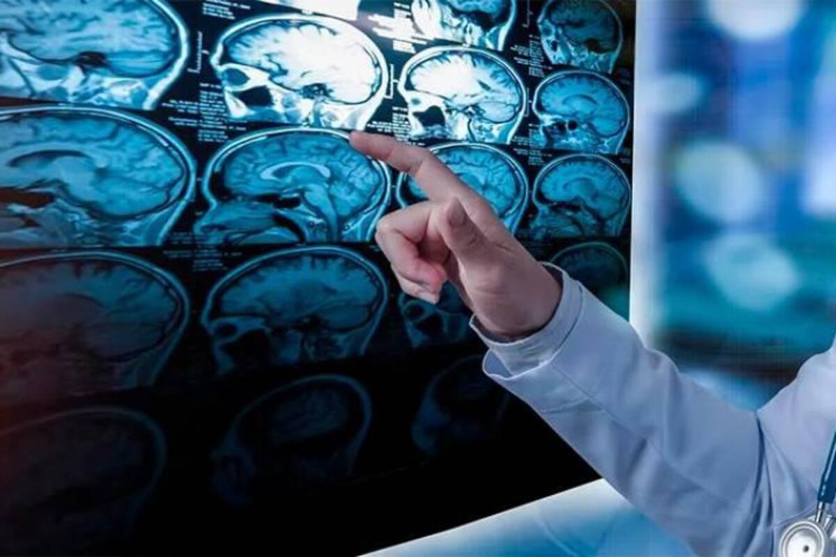 La Esclerosis Múltiple es considerada una enfermedad huérfana o rara.