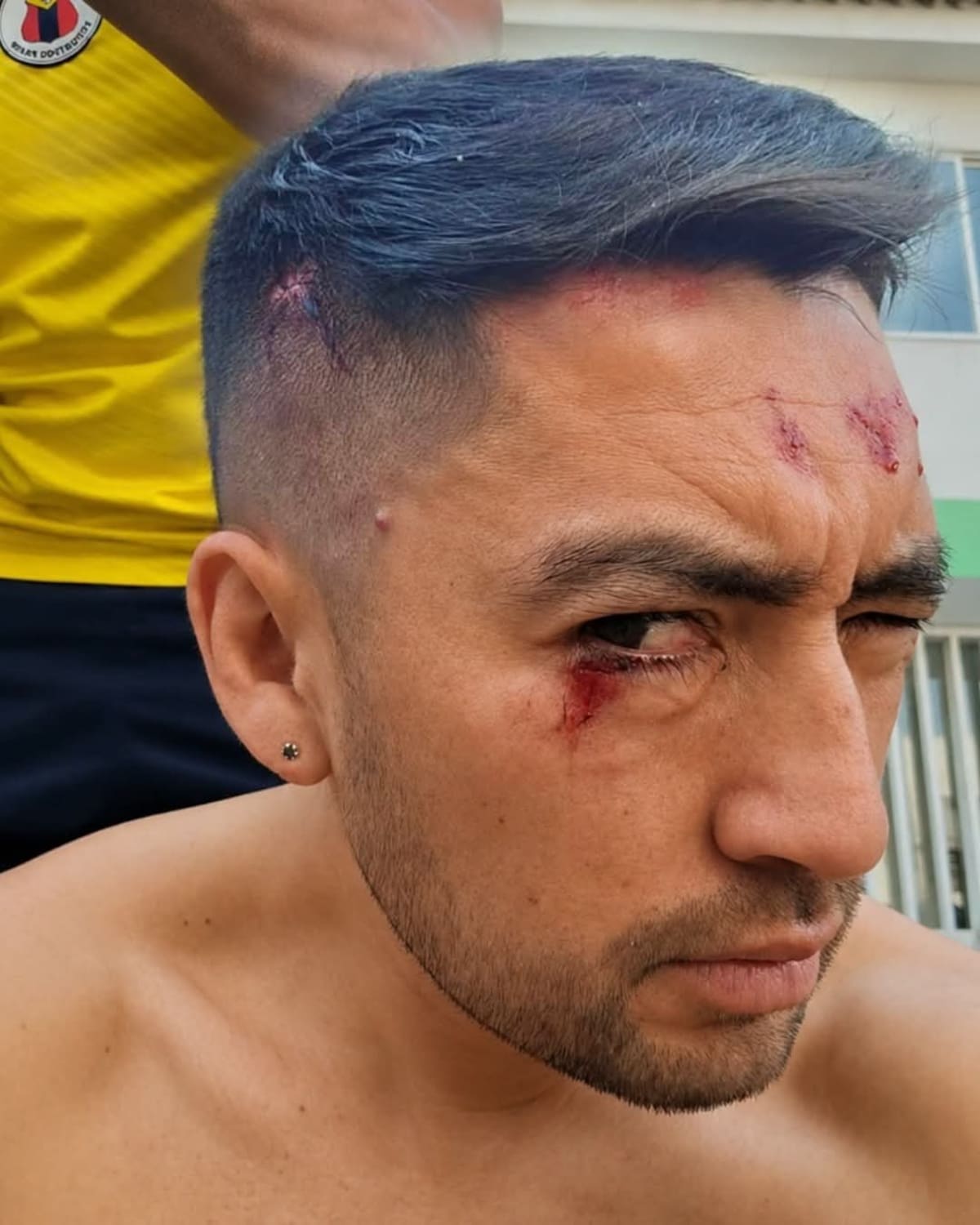 Exjugador del Atlético Bucaramanga sobrevivió al terremoto en Cali: quedó herido tras colapso de hotel.