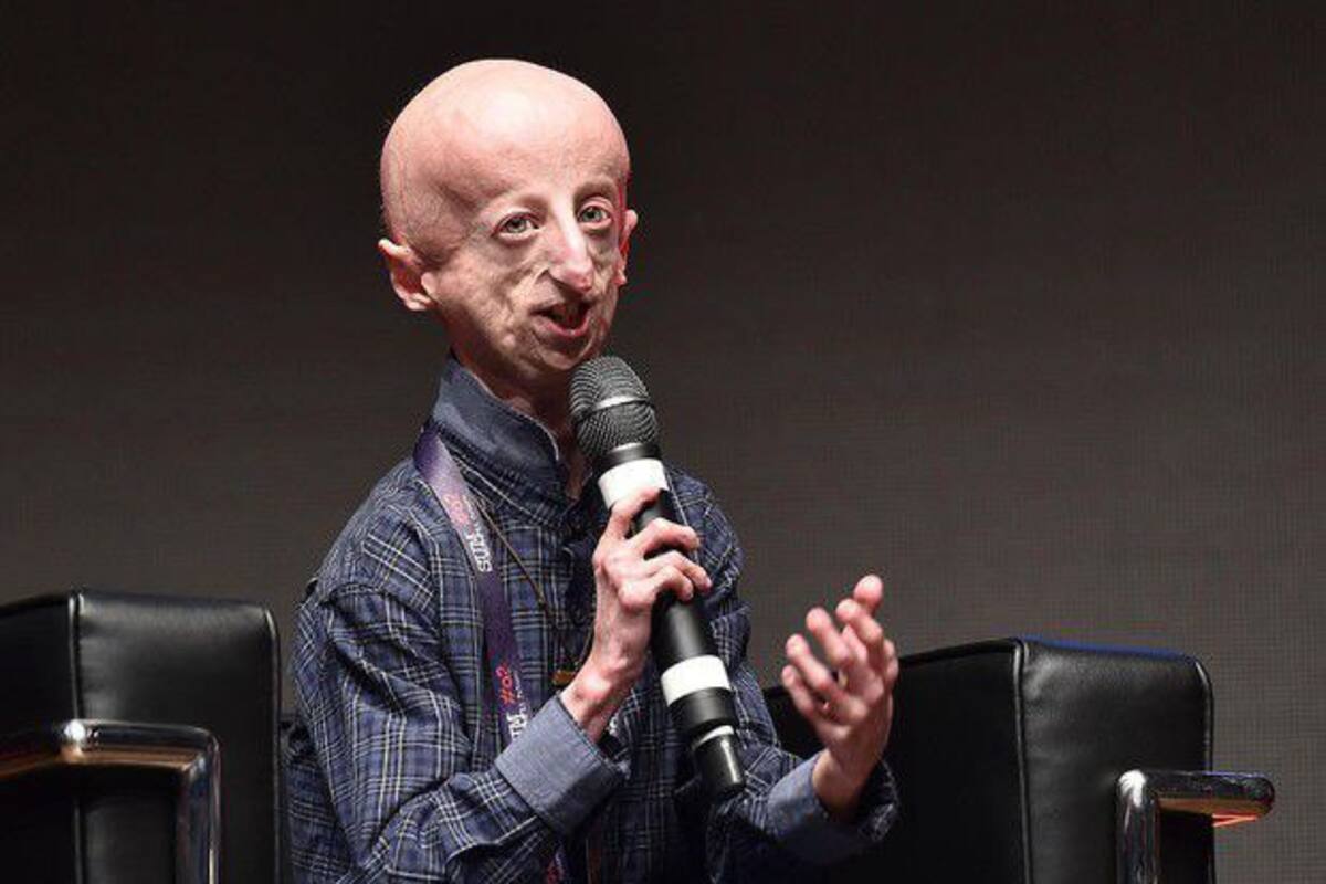 Falleció Sammy Basso, el hombre con envejecimiento prematuro. Foto: Tomada de X