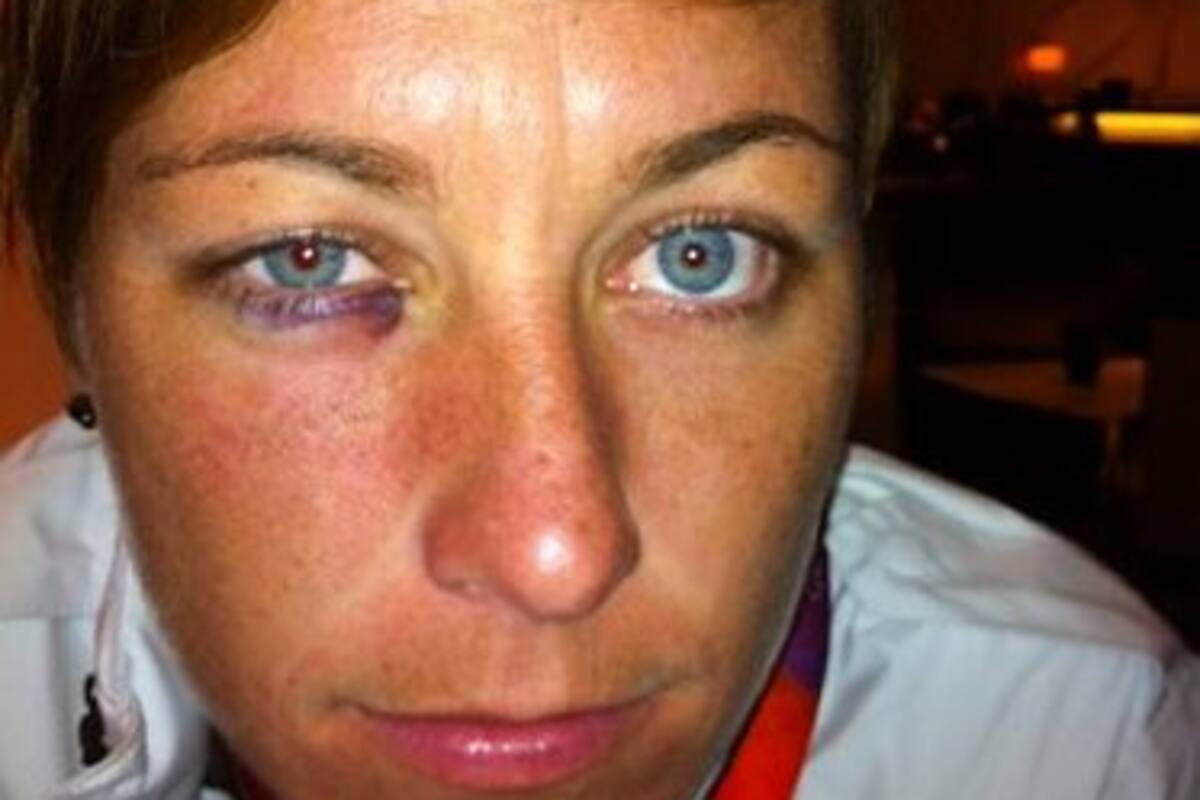 Así le quedó el ojo a la jugadora americana (Foto: Tomado de Internet/ VANGUARDIA LIBERAL)