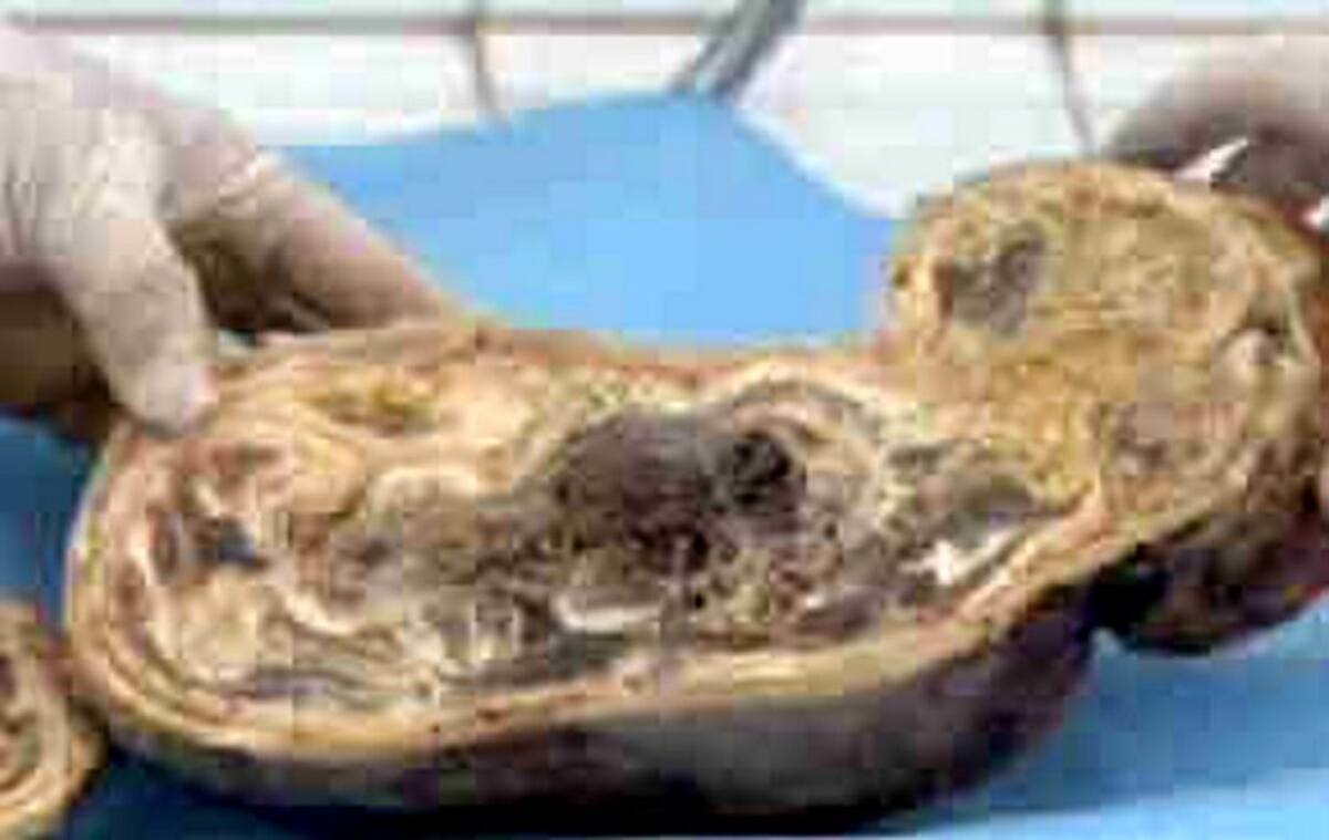 Pasó 46 años embarazada y dio a luz un bebé de piedra (Foto: Tomado de Internet/ VANGUARDIA LIBERAL)
