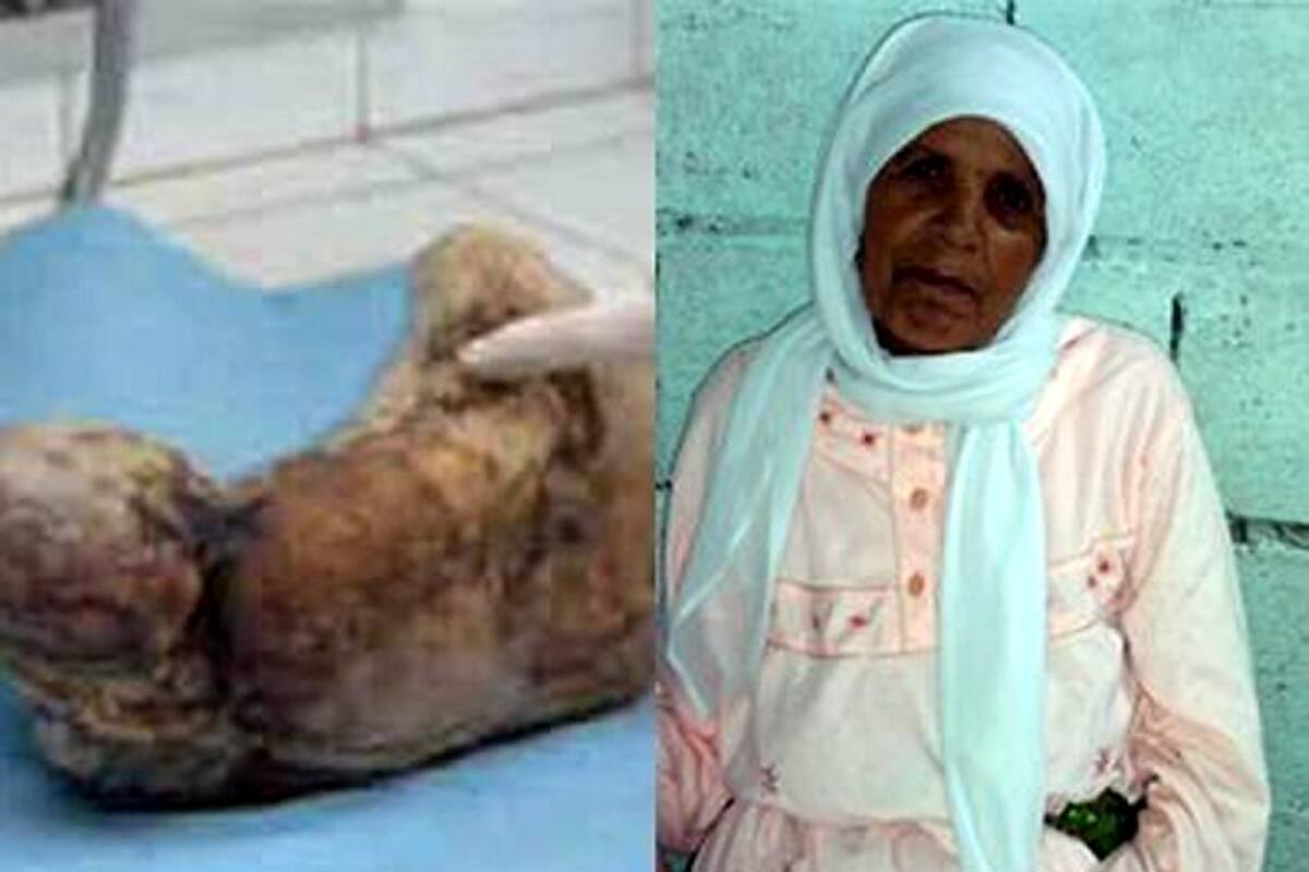 Pasó 46 años embarazada y dio a luz un bebé de piedra (Foto: Tomado de Internet/ VANGUARDIA LIBERAL)