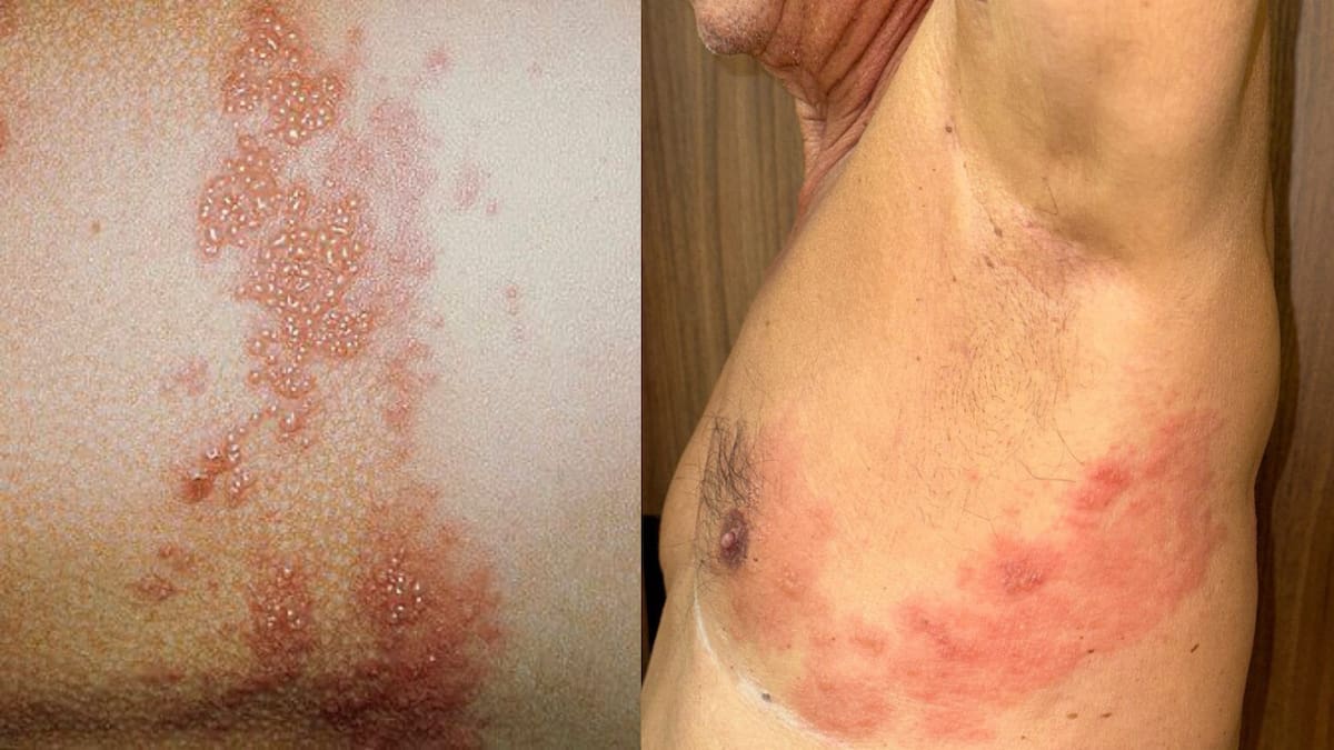 El herpes zóster o “culebrilla” puede aparecer años después de haber tenido varicela. Imágenes de referencia tomadas de: Istock