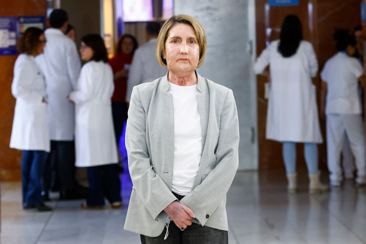 Carmen, la primera paciente en recibir un trasplante de cara de una donante que recibió una eutanasia, posa para los medios de comunicación antes de la rueda de prensa que se ha celebrado en el Hospital Vall d'Hebron de Barcelona para explicar el procedimiento. EFE/Quique García