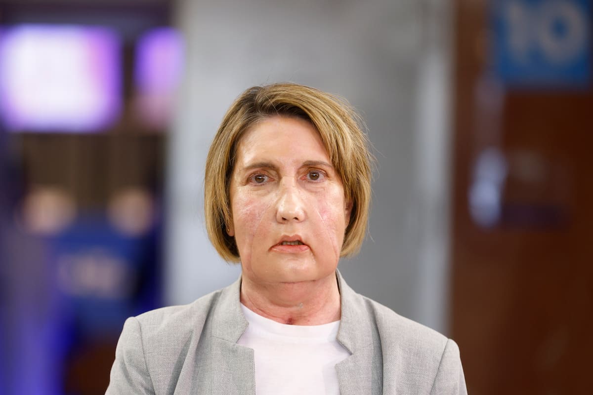 Carmen, la primera paciente en recibir un trasplante de cara de una donante que recibió una eutanasia, posa para los medios de comunicación antes de la rueda de prensa que se ha celebrado en el Hospital Vall d'Hebron de Barcelona para explicar el procedimiento. EFE/Quique García