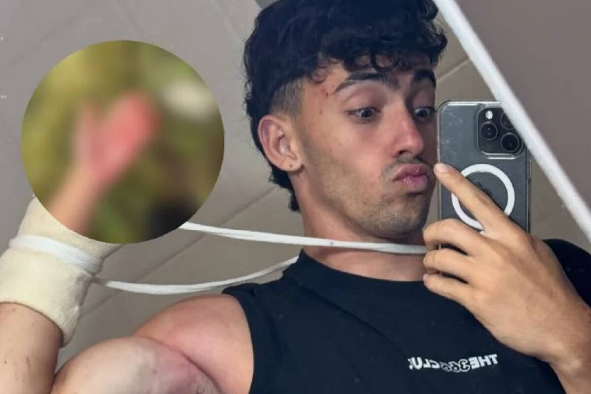 Así quedaron los dedos del influencer argentino Gero Arias. Foto tomada de redes sociales/VANGUARDIA