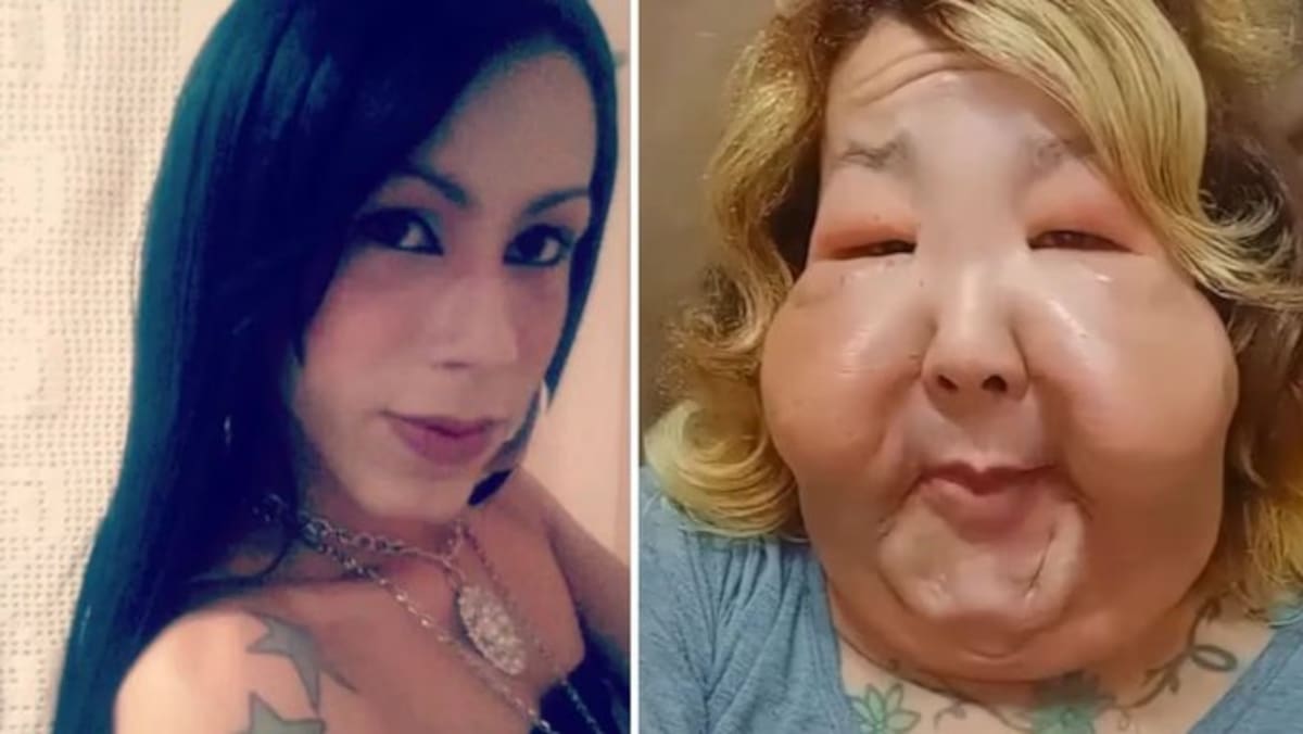 La historia detrás de la influencer que quedó desfigurada tras un retoque estético clandestino.