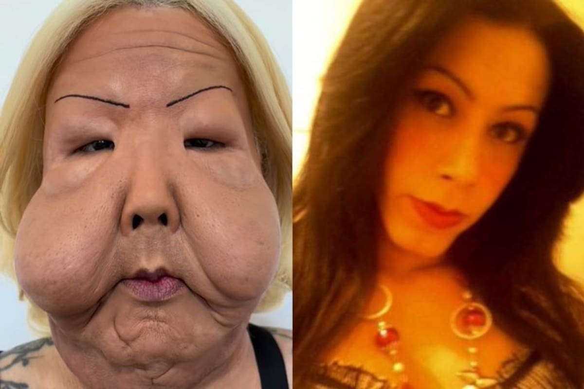 Juliana Oliveira, influencer trans, inicia un proceso de reconstrucción facial años después de que accidentalmente le aplicaran aceite mineral en el rostro.