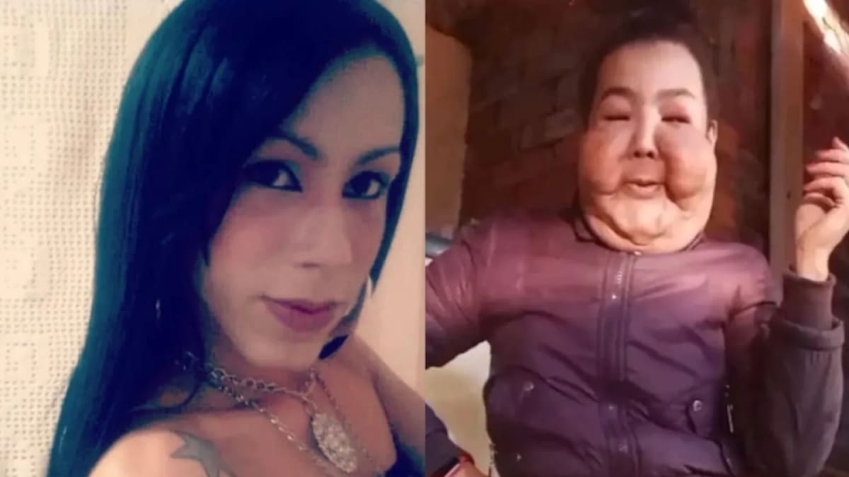 Le inyectaron aceite y laxantes: el caso de influencer que impacta las redes sociales.