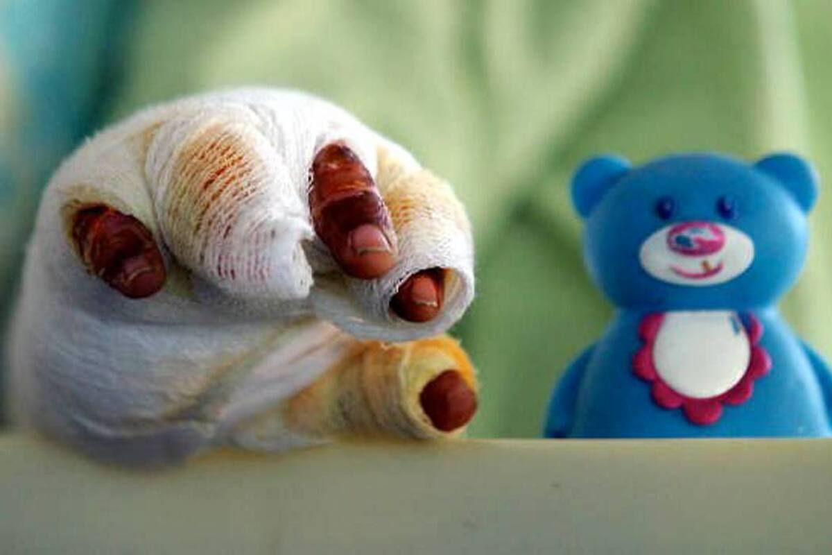 Adultos y menores de edad han resultado quemadas con pólvora en Santander durante los primeros días de diciembre. Alerta de las autoridades.