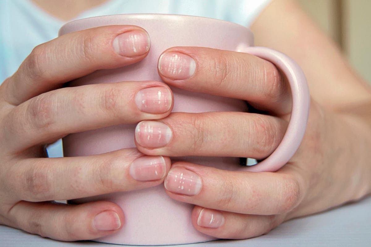 ¿Cuál es la causa de las manchas blancas en las uñas? Se trata de un fenómeno que, según los expertos, es común, pero que en algunos casos puede ser indicio de una enfermedad grave.