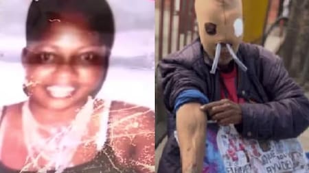 María Consuelo, víctima de ataque con ácido, desistió de la eutanasia tras recibir ayuda para cirugías