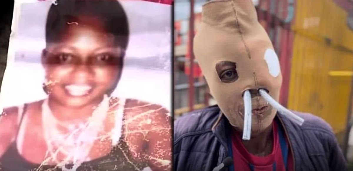 María Consuelo Córdoba, víctima de un ataque con ácido en el 2000, pide la eutanasia. Foto: Captura de video Instagram Canal CityTV